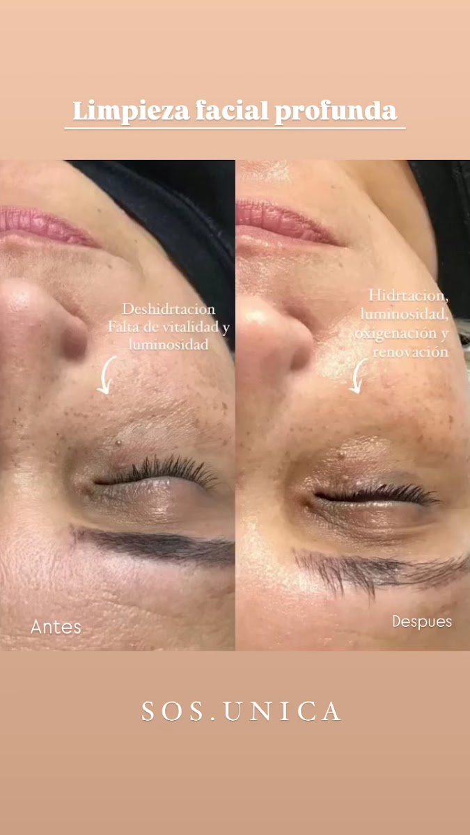 Sesión de cosmiatría facial en SOS Única Ituzaingó